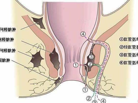 肛瘘手术比生孩子还疼吗,肛瘘手术疼痛可以承受吗