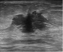 乳腺检查有疑似结节是什么意思,乳腺彩超报告中隐藏的秘密