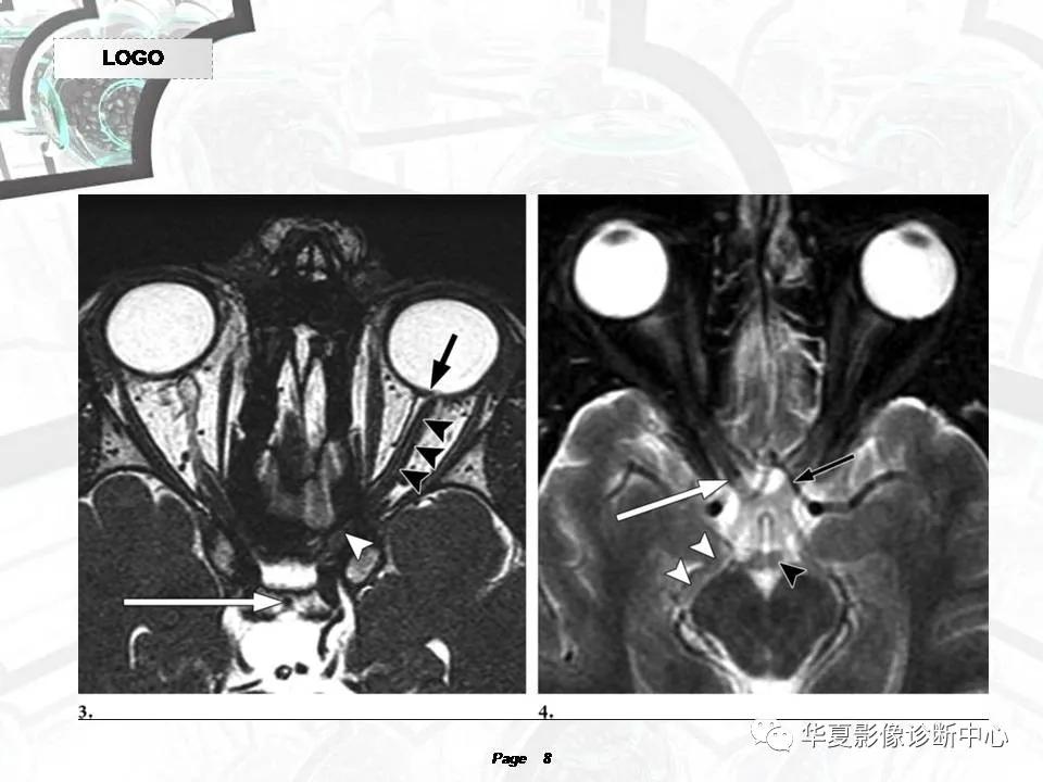 磁共振颅神经扫描是定位在哪,颅神经图谱