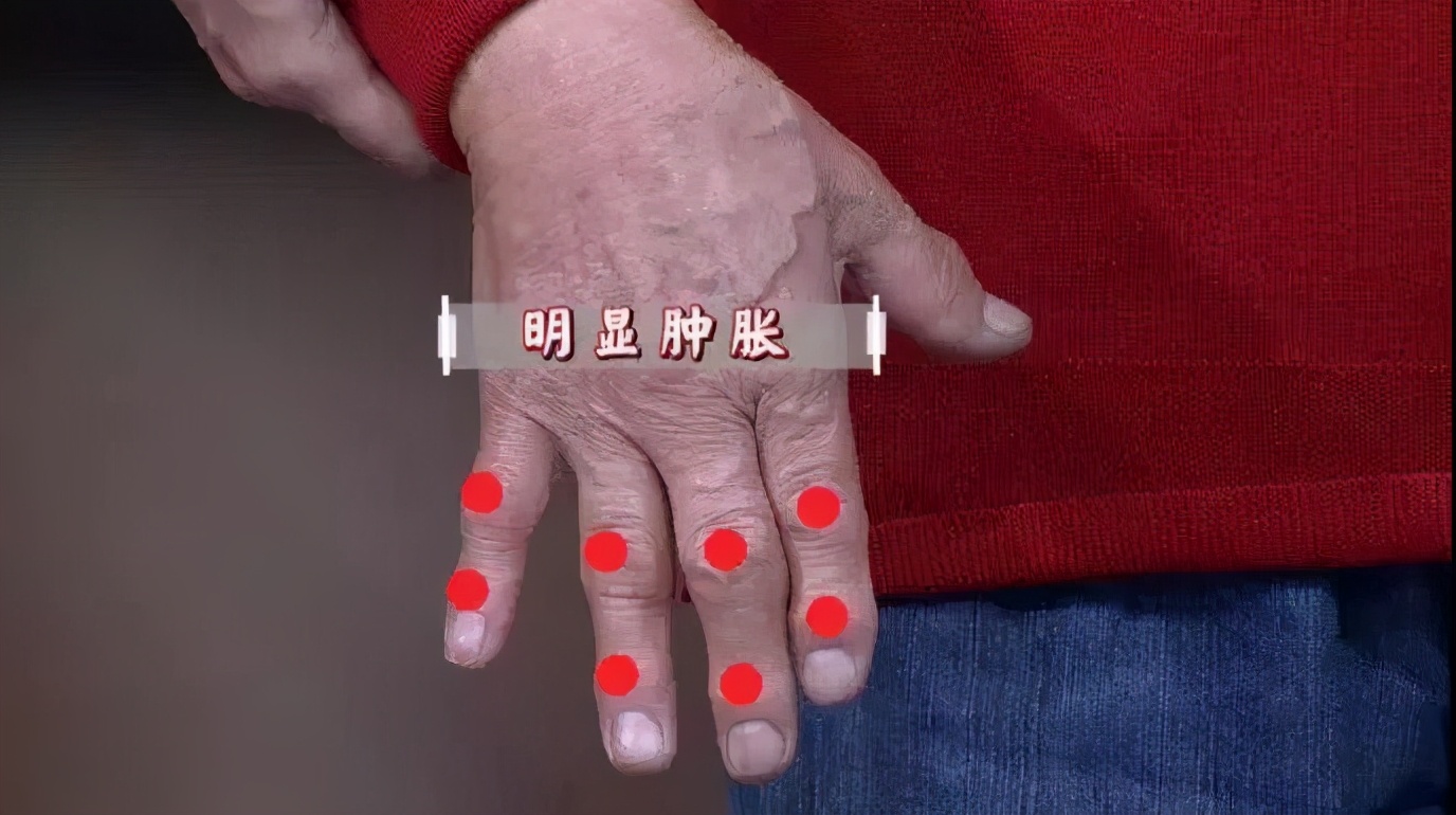 风湿性老寒腿怎么治疗,老寒腿是不是风湿性关节炎