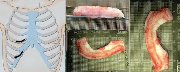 隆鼻方法,隆鼻比较好的方法