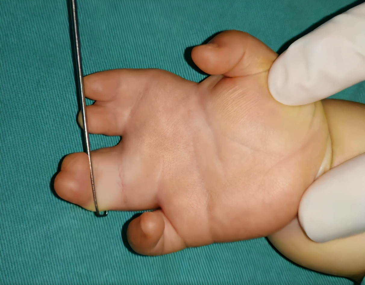 并指畸形免植皮案例,并指畸形