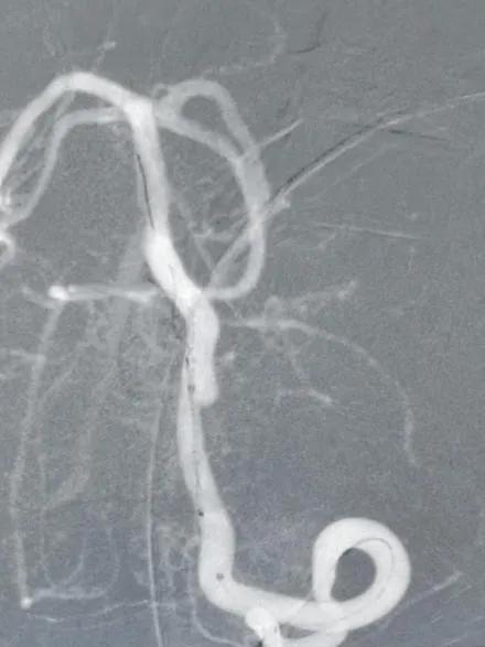 淄博市中心医院治疗动脉瘤,tubridge动脉瘤支架医保报销多少