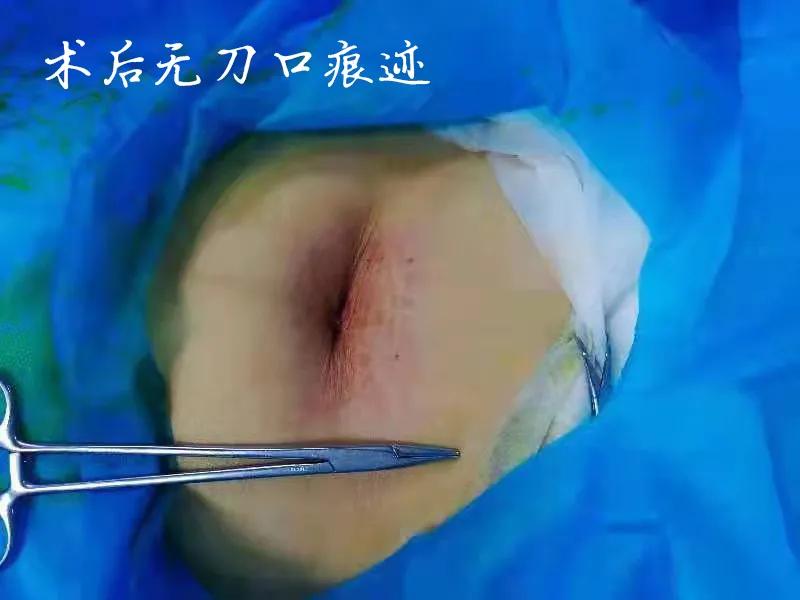 「迈上新台阶」玉田县中医医院妇科独立开展首例单孔腹腔镜手术