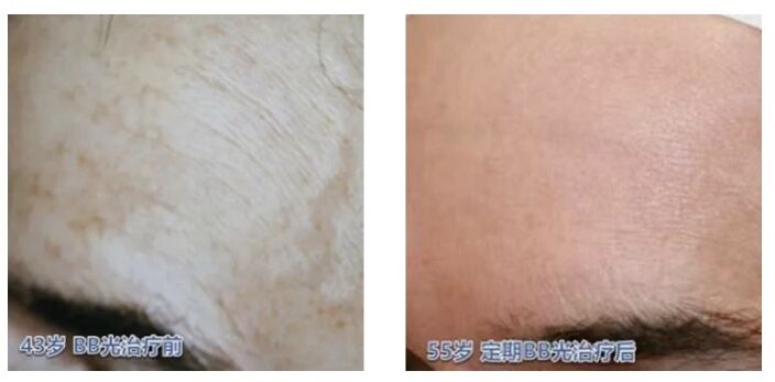 光子嫩肤基础护肤,基础护肤的光子嫩肤