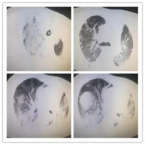 罕见病误诊的真实案例,误诊漏诊导致病人肿瘤癌变