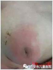 挤压新生宝宝的乳腺？挤出的只能是痛苦和后悔！