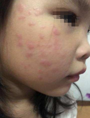 婴儿脸上长痘痘一直用手搓,一岁宝宝脸上一揉就起小疹子