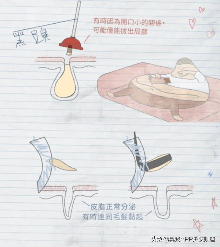 顽固黑头怎么去除最有效,变美小知识黑头怎么去掉