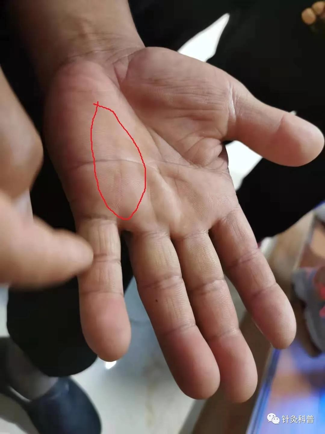 针灸最新疗法300例,传统针灸治疗杂病