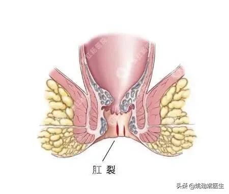 肛裂想生孩子如何应对,儿童肛裂擦什么药