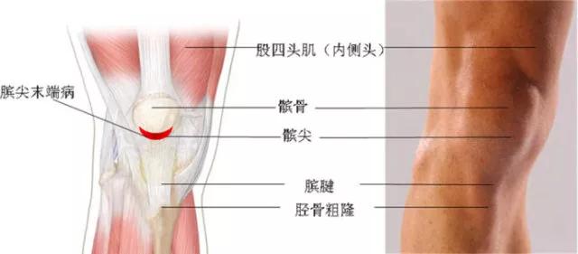 髌下肌腱炎需要多久才能好,髌肌腱损伤多久才能完全恢复