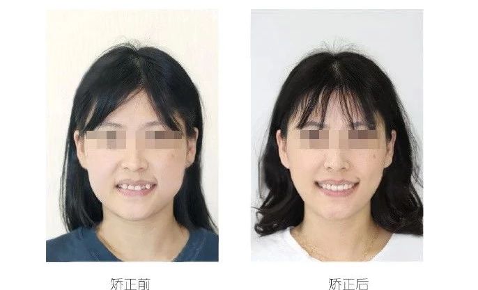 整牙齿堪比整容,矫正牙齿大概多少钱龅牙