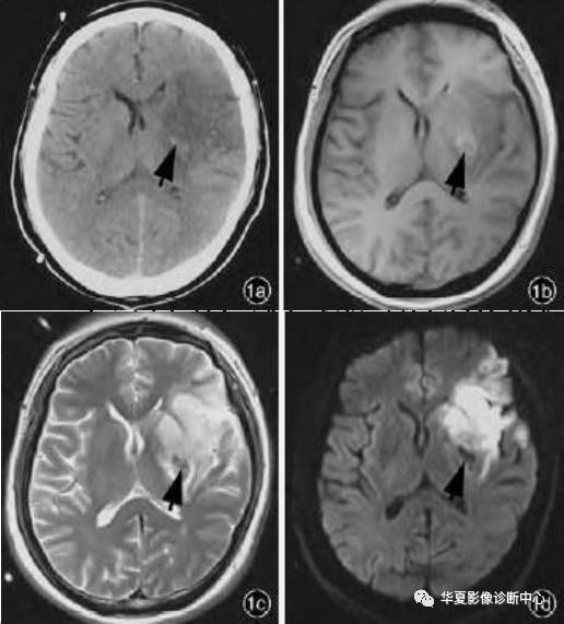各型脑水肿影像及病理、生理解析