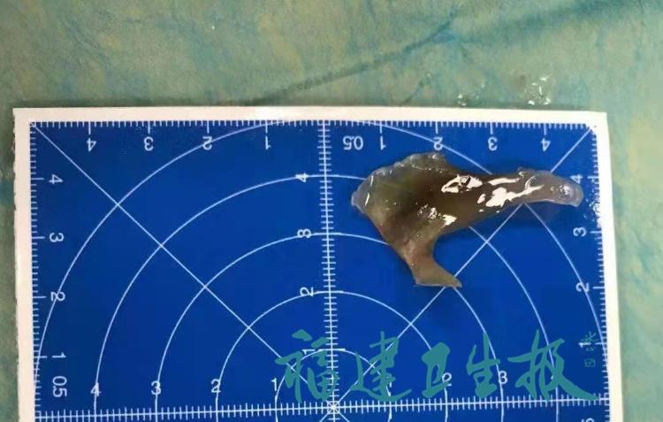 老人误吞3厘米鱼刺,误吞鱼骨最好的土方法