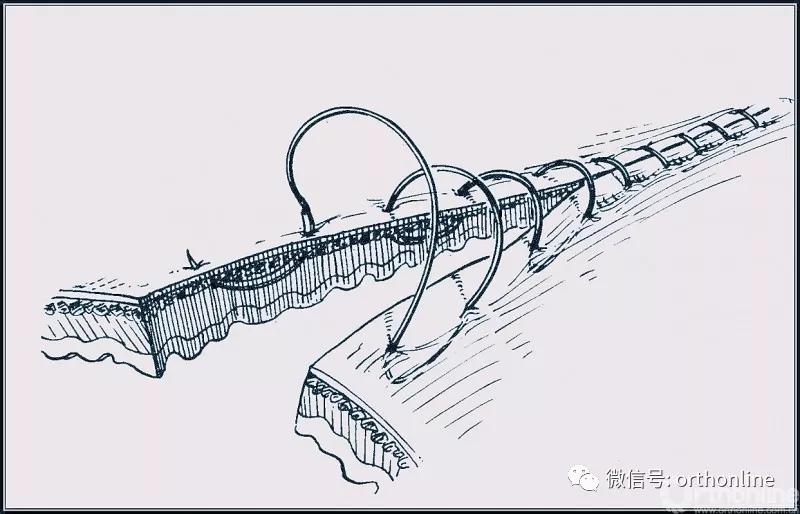 十种外科基本缝合方式详解,手术切口缝合有哪几种