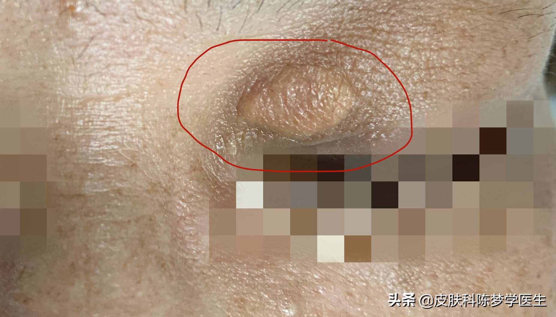 脖子上小肉球和丝状疣的区别,脖子上长了个细长的小肉球严重吗