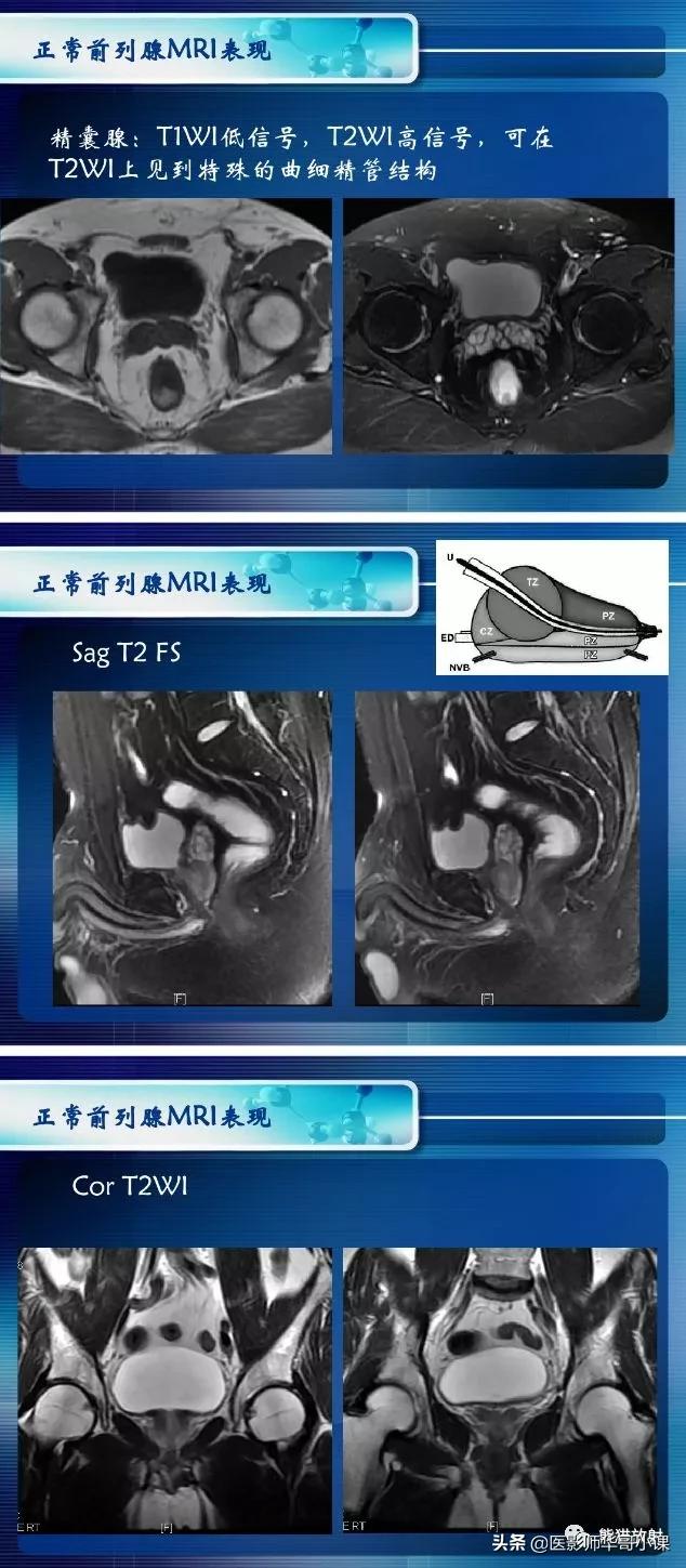 前列腺磁共振影像解剖,前列腺mri正常诊断报告模板