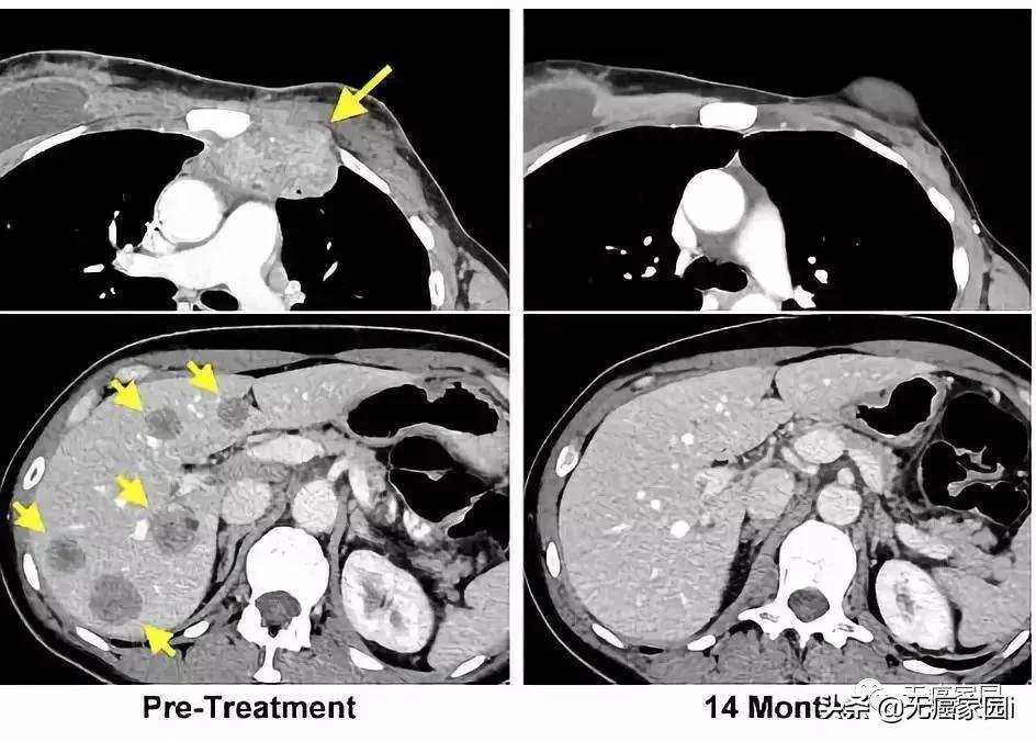 细胞激活治疗癌症的进展,细胞治疗新型癌症