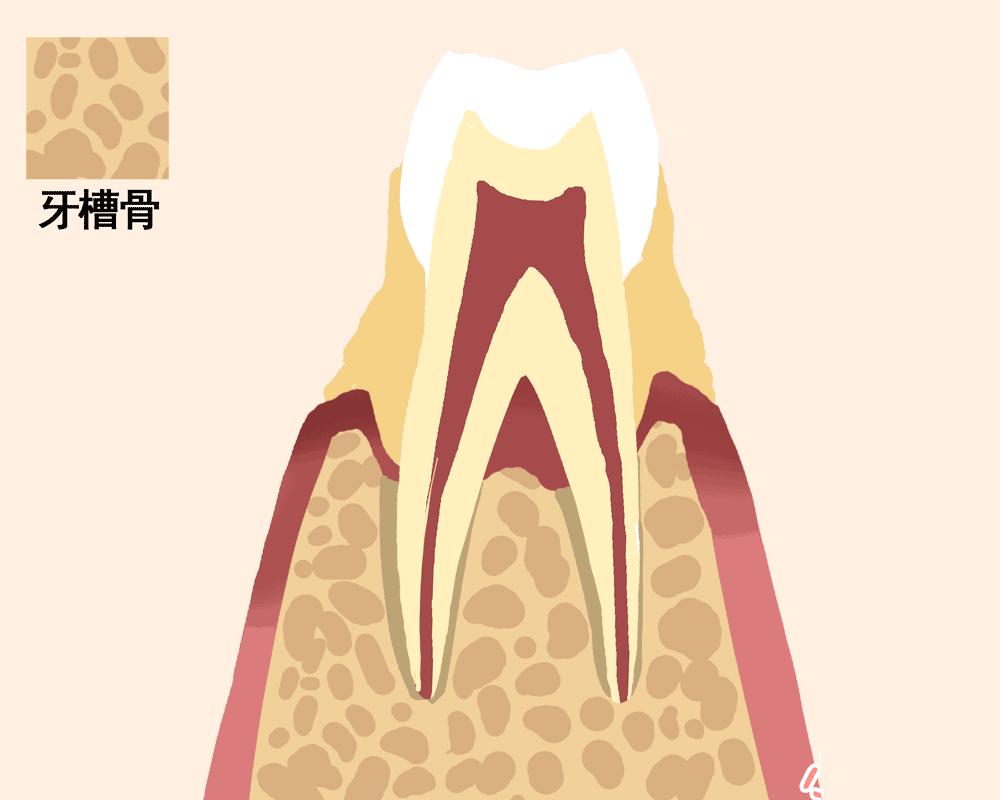 牙槽骨吸收严重可以补救吗,牙槽骨吸收严重种牙就不吸收了么