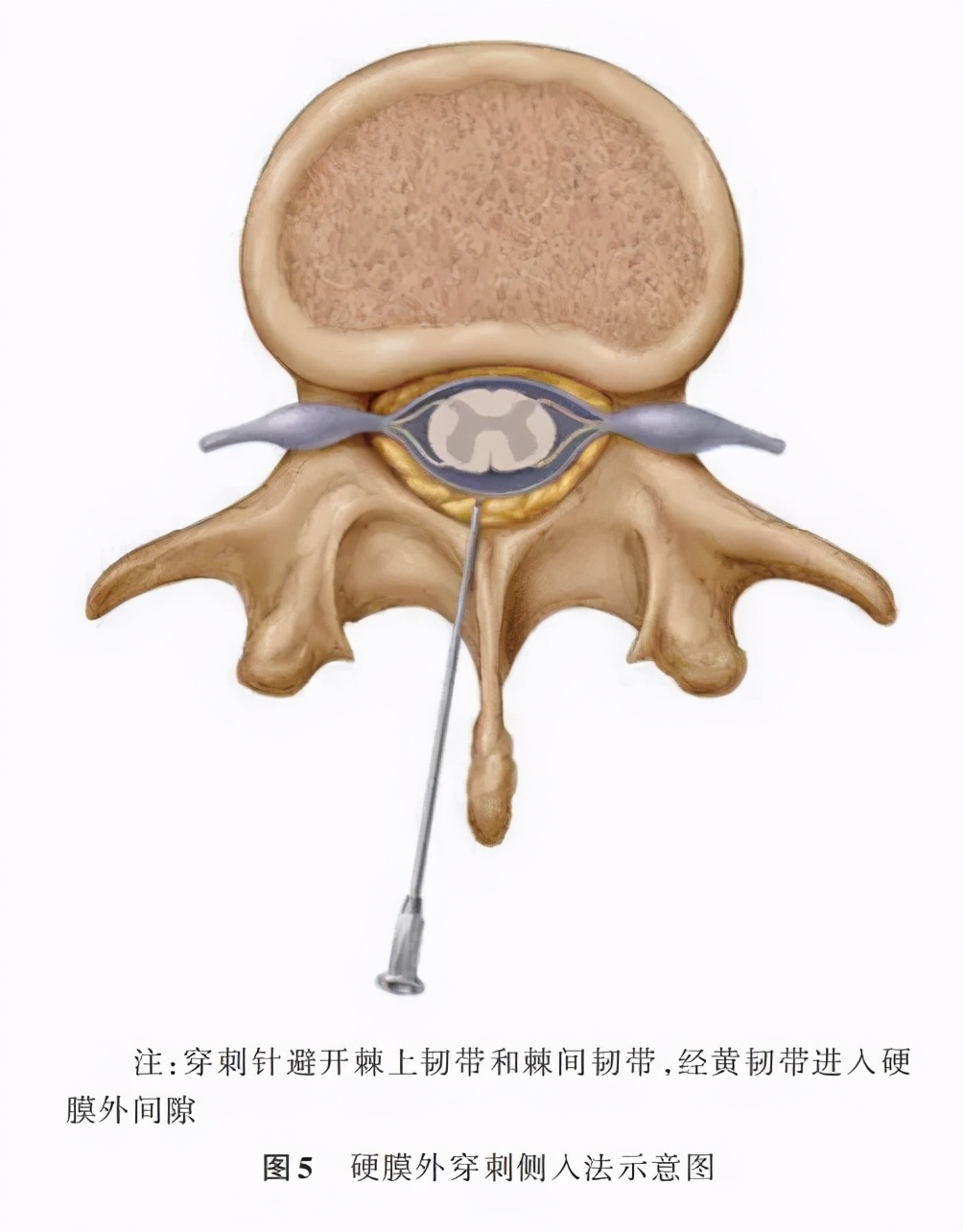 连续硬膜外阻滞术,星状神经节阻滞疗法中国专家共识