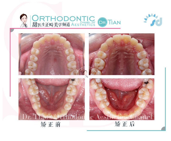 47岁大龄矫正，骨性嘴突+牙缝大+牙周炎｜曹博士正畸复杂病例分享