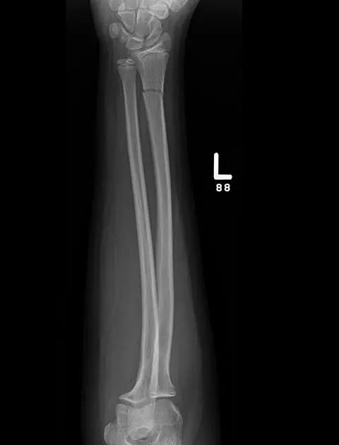 几种严重骨折医学名称,常见的骨折有哪些名称