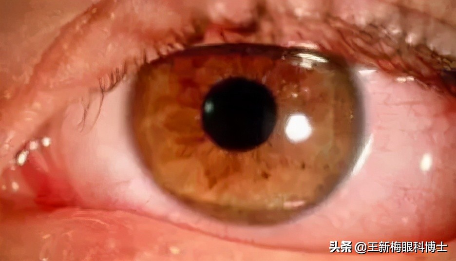 春季儿童过敏性结膜炎,儿童过敏性结膜炎眼睛痒怎么办