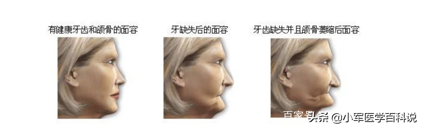 成年人牙齿破损还能长吗,成人牙齿坏了只剩牙根