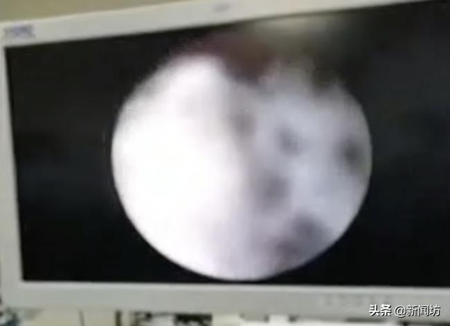 3岁女童出现少量出血是怎么回事,两岁女童少量出血