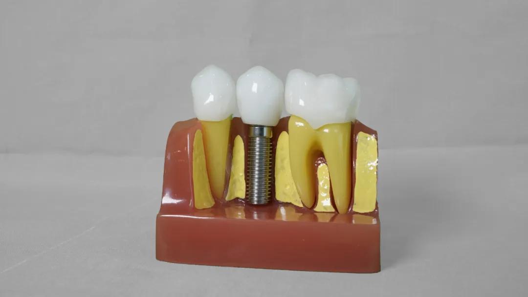 种牙是通过什么原理让它牢固的,种牙种钉过程