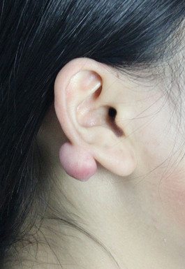 疤痕体质用什么方法祛疤好,欣奕除疤凝胶对疤痕体质有效果吗