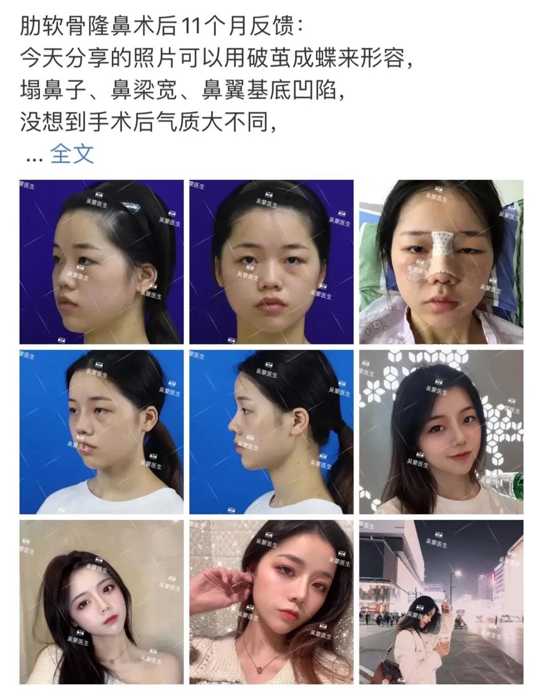 鞠婧祎鼻子整过吗,鞠婧祎的鼻子整过吗