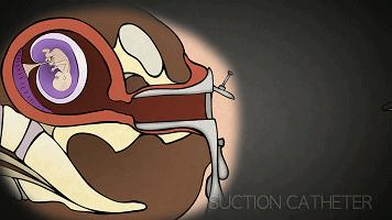 堕胎到底有没有恶果,堕胎真的那么可怕吗