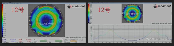 ok镜一周不戴近视更厉害吗,戴了ok镜真的可以恢复视力吗