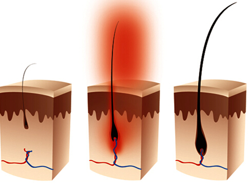 毛囊萎缩退化会脱发？教你三个方法，判断毛囊是否还活着