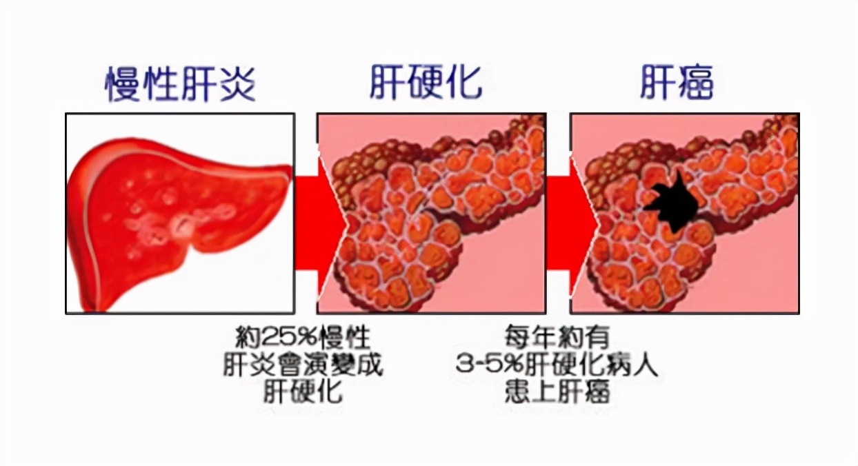 肝硬化症状,肝硬化药