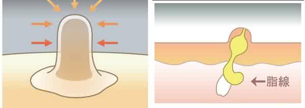 眼睛上长了黄色小粒,眼睛里面有黄色的麦粒肿怎么搞