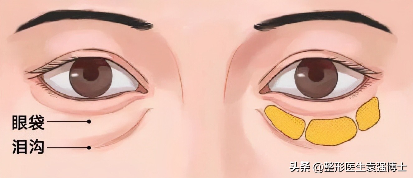 最简单最有效的祛眼袋方法,做了眼袋后悔