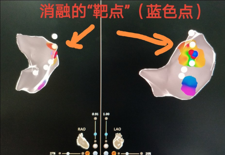 孕妇心动过速外加有点心肌缺血,怀孕心电图窦性心动过速心慌胸闷