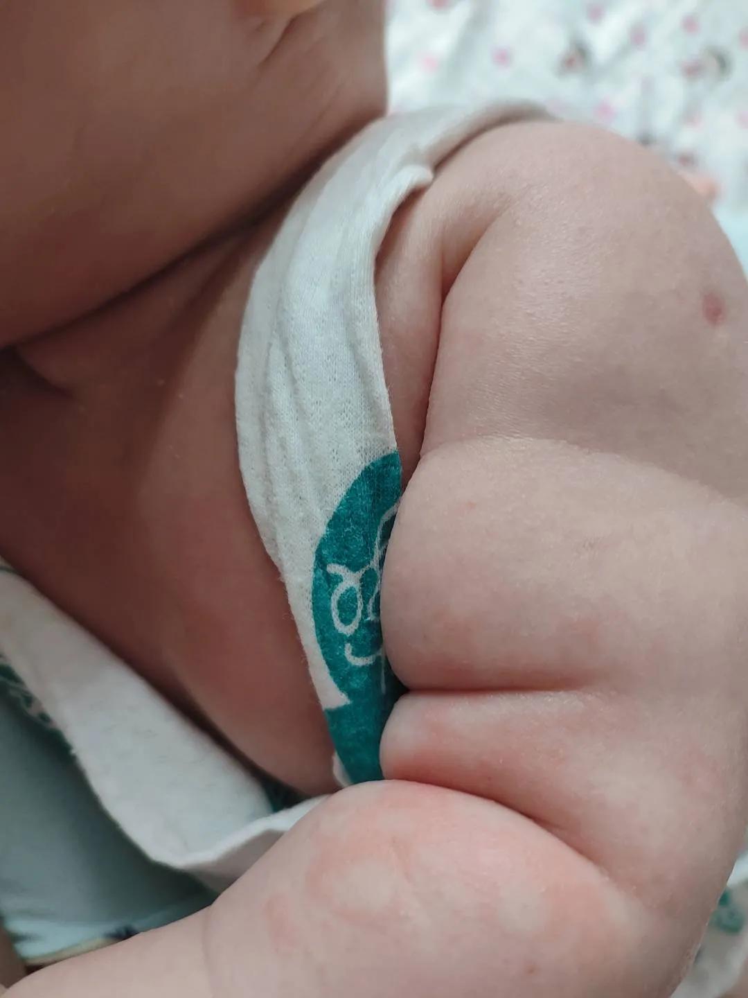 宝宝大作战8-9,宝宝湿疹大作战