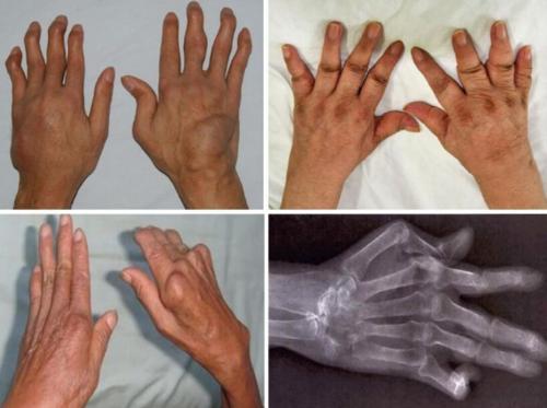 类风湿患者身上起一片疙瘩,类风湿关节有小疙瘩