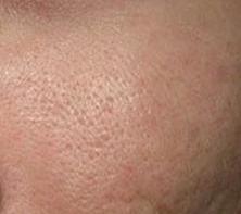 毛孔大用收缩毛孔护肤品有效吗,毛孔收缩水能治毛孔大吗