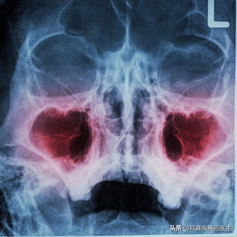 鼻窦炎为什么会头痛图解,鼻咽癌头痛和鼻窦炎头痛的区别