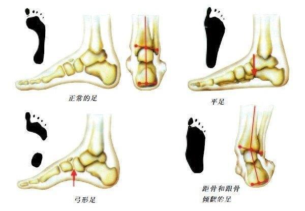 儿童鞋与骨骼发育,1-3岁孩子脚发育