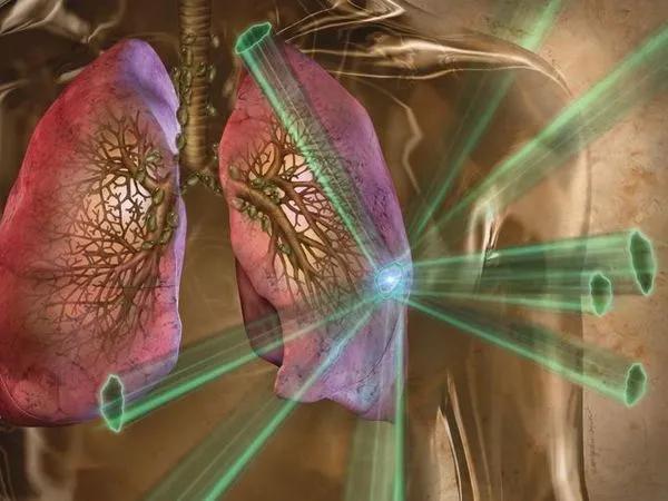 肺大细胞神经内分泌癌综合治疗进展