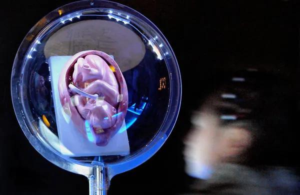 女性身体里被遗忘的节育环,被遗忘的节育环