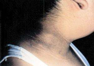 黑棘皮病抠掉留下的黑印怎么办,黑棘皮症怎么去除