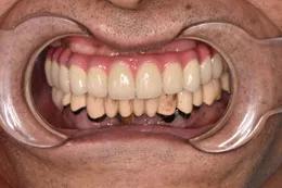 长沙牙齿种植的费用,长沙半口种植牙齿的过程