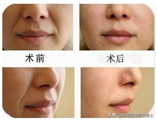 去掉法令纹最好的方法的视频,不用任何化妆品去掉眼部法令纹